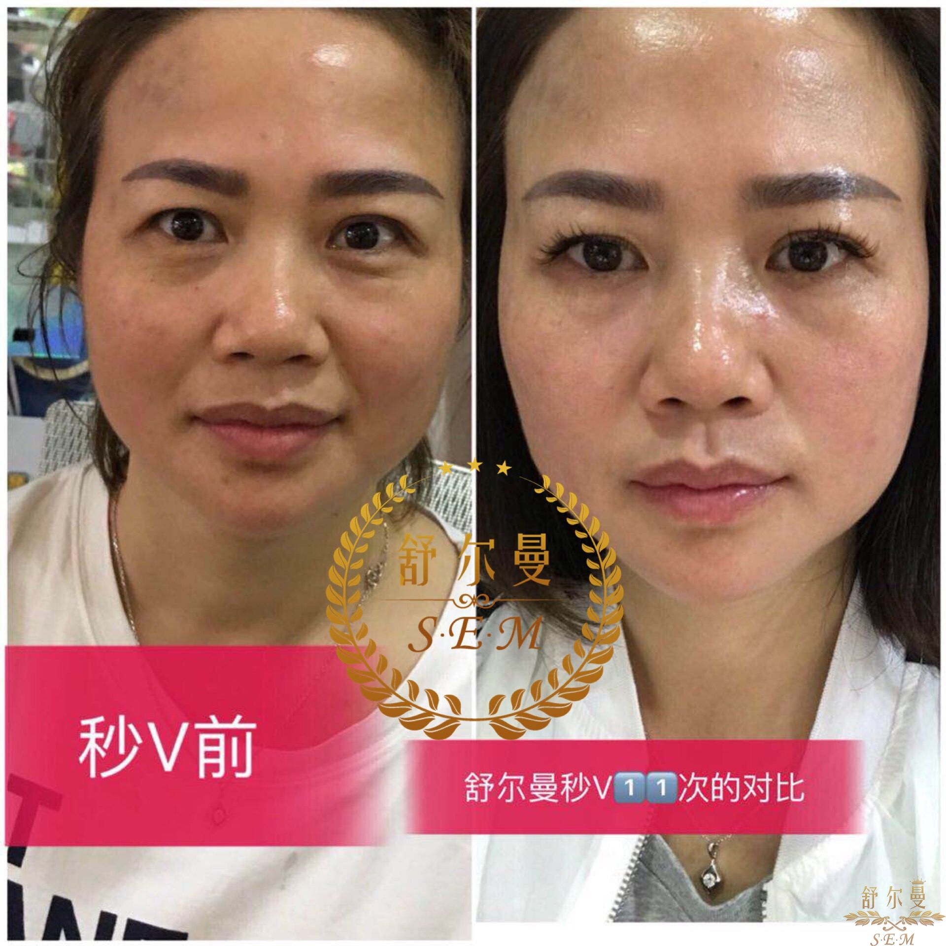 PRP for Facial Rejuvenation | Cynthia Golomb, MD | Dermatology Boutique
